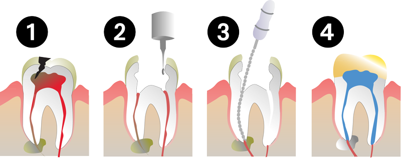 Root Canal Process