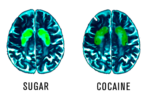 sugar cocaine brain scan comparison